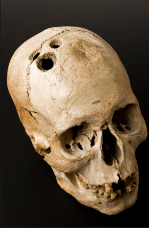 Trepanacija yra sena praktika gręžti skylę kaukolėje. Tai viena seniausių medicininių procedūrų, žinoma žmonijai.