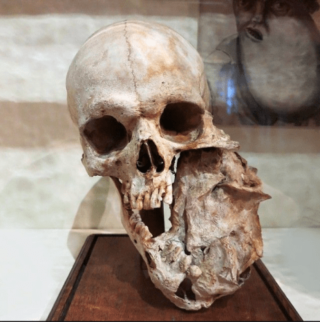 Kaukolė su apatinio žandikaulio naviku prie Bleuland kabineto Utrechto universiteto muziejuje, Nyderlanduose