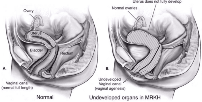 Üreme organlarının az gelişmiş olduğu veya tamamen bulunmadığı MRKH'nin çeşitli varyasyonları vardır. Bununla birlikte, MRKH'li kadınlar için dış genital organ ve meme gelişimi tipik olarak normaldir.