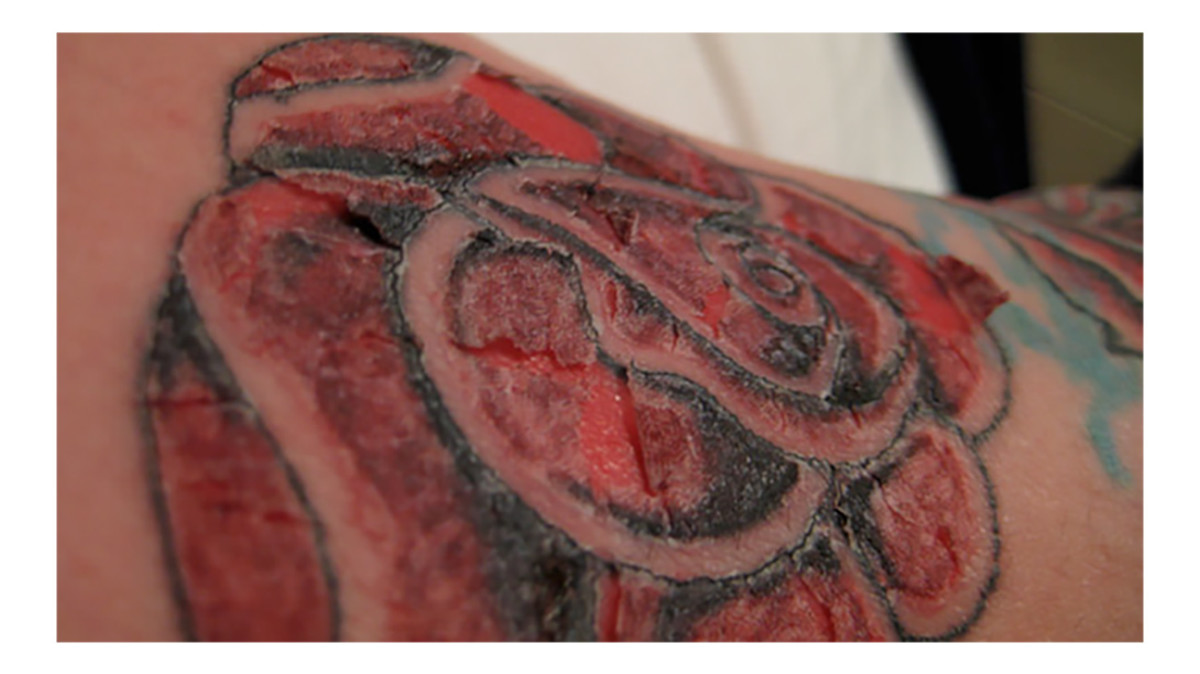 Scabbing_tattoo_infection-1296x728-body_image_2
