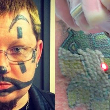 Ihr ultimativer Leitfaden zur Tattoo-Entfernung